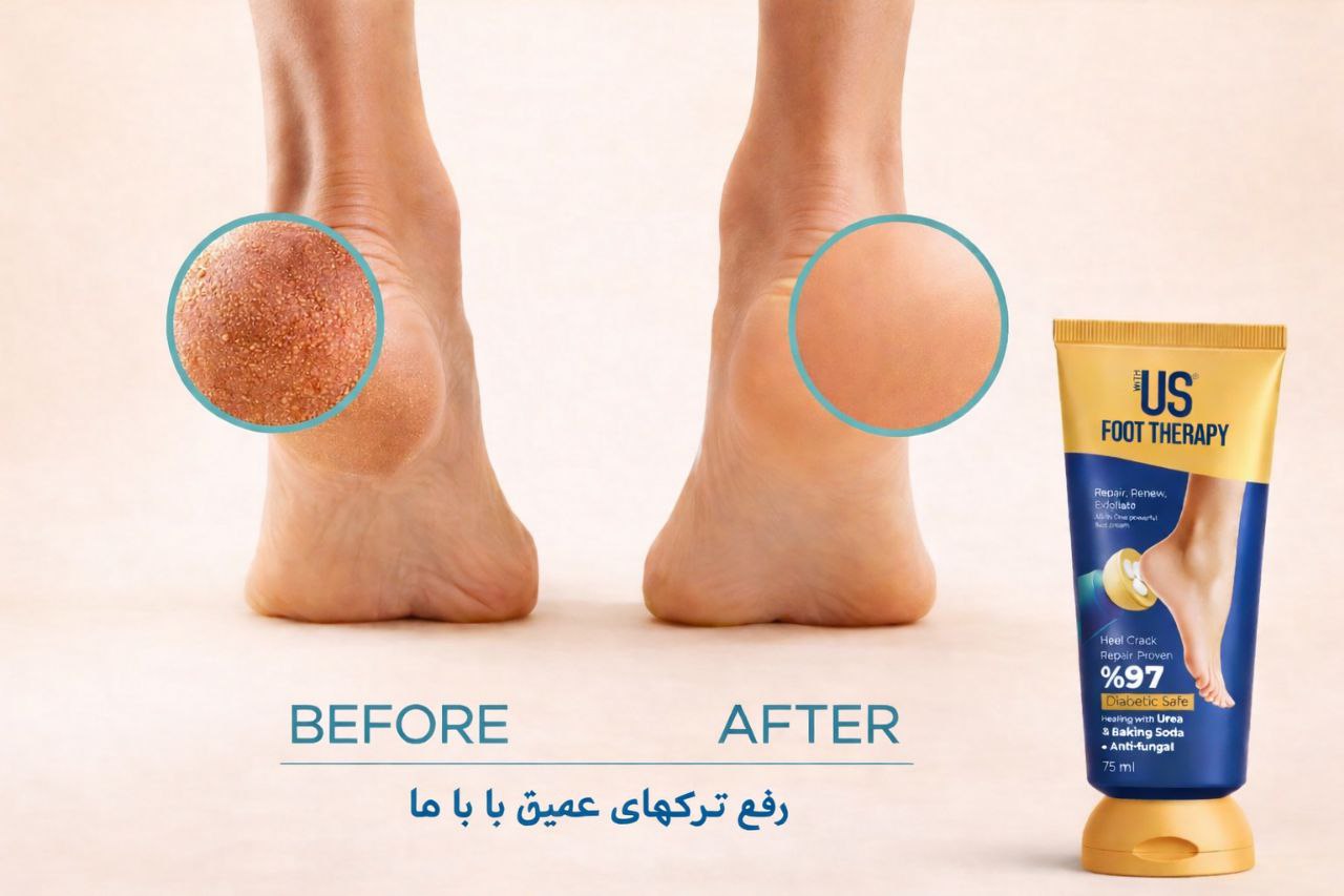 کرم ترک پای ویت‌آس